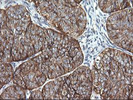 Immunohistochemical analysis of paraffin-embedded Human ovary adenocarcinoma tissue labeling VTI1A with ab156793 at 1/150 dilution.