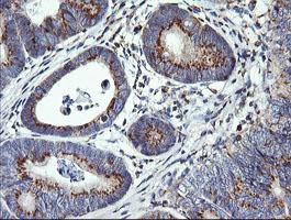 Immunohistochemical analysis of paraffin-embedded Human pancreas carcinoma tissue labeling VTI1A with ab156793 at 1/150 dilution.