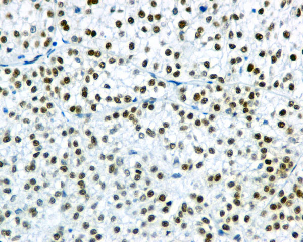 ab169526 showing +ve staining in Human hepatocellular carcinoma tissue.