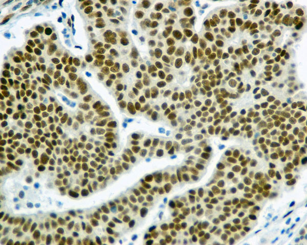 ab169526 showing +ve staining in Human ovarian carcinoma tissue.