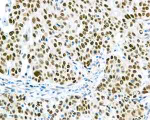 Immunohistochemical analysis of paraffin embedded Human cervical carcinoma tissue labeling WDR4 with ab169526 antibody at 1/250.