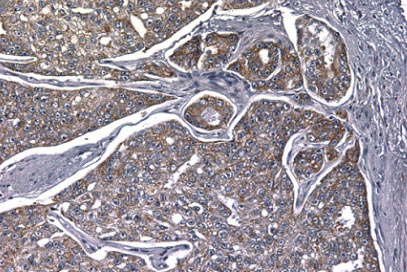 Immunohistochemical analysis of prostate cancer tissue, staining Wilms Tumor Protein with ab96792. Antigen retrieval was performed by heat mediation in a citrate buffer. Samples were incubated with primary antibody before a biotinylated goat anti-rabbit IgG secondary antibody. Staining was detected using DAB.