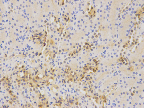 Immunohistochemistry (Formalin/PFA-fixed paraffin-embedded sections) analysis of human kidney cancer tissue labelling Wilms Tumor Protein with ab180840 at 1/500. Magnification: 400x.