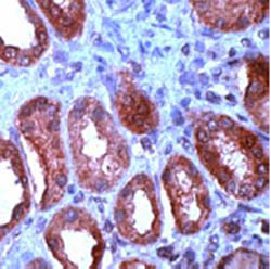 Breast carcinoma cells stained with ab15251 (Immunohistochemistry, paraffin sections);