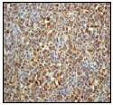 Ab51256 (1:50) staining human WSTF in human lymphoma tissue by immunohistochemistry using paraffin embedded tissue.