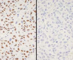 Detection of Mouse XRCC1 (phospho S518 + T519 + T523) by Immunohistochemistry.Samples: FFPE serial sections of Mouse squamous cell carcinoma. Mock phosphatase treated section (left) or calf intestinal phosphatase-treated section (right) immunostained for XRCC1 (phospho S518 + T519 + T523).Antibody: ab84417 used at a dilution of 1/250. Detection: DAB staining.