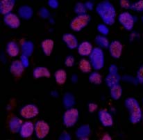 Detection of Human XRCC1 (phospho S518 + T519 + T523) by Immunofluorescence.Sample: FFPE section of Human breast carcinoma.Antibody: ab84417 used at a dilution of 1/100.Detection: Red-fluorescent Alexa Fluor 555 goat anti-rabbit IgG used at a dilution of 1/500.