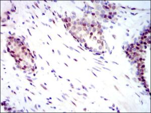 ab124474, at 1/200 dilution, staining YAP1 in paraffin-embedded Human prostate cancer tissue by immunohistochemistry followed by DAB staining.