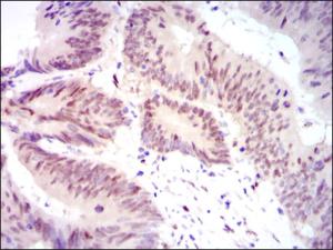 ab124474, at 1/200 dilution, staining YAP1 in paraffin-embedded Human rectum cancer tissue by immunohistochemistry followed by DAB staining.