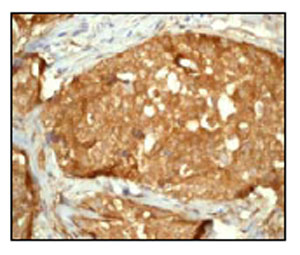 Immunohistochemical staining of YAP1 in paraffin embedded human breast carcinoma tissue using ab52771 at a 1/100 dilution.