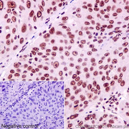 Immunohistochemistry (Formalin/PFA-fixed paraffin-embedded sections) analysis of human cervix carcinoma tissue labelling YY1 with purified ab109237 at 1/500. Heat mediated antigen retrieval was performed using Tris/EDTA buffer pH 9. ab97051, a HRP-conjugated goat anti-rabbit IgG (H+L) was used as the secondary antibody (1/500). Negative control using PBS instead of primary antibody. Counterstained with hematoxylin.