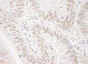ab91618, at 1/250 dilution, staining Smek1 in formalin-fixed paraffin-embedded Human colon carcinoma tissue by Immunohistochemistry using DAB staining.