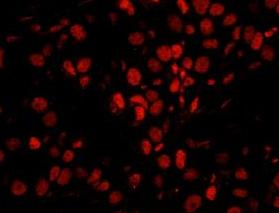 ab91618, at 1/250 dilution, staining Smek1 in formalin-fixed paraffin-embedded Human breast carcinoma tissue by Immunohistochemistry using Red-fluorescent goat anti-rabbit IgG highly cross-adsorbed Antibody Hilyte PlusTM 555 secondary antibody at a dilution of 1/100.
