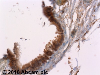ab38929 (4µg/ml) staining MMP1 - Hemopexin domain in human gallbladder using an automated system (DAKO Autostainer Plus). Using this protocol there is strong cytoplasmic staining of epithelial cells.Sections were rehydrated and antigen retrieved with the Dako 3 in 1 AR buffer citrate pH6.1 in a DAKO PT link. Slides were peroxidase blocked in 3% H2O2 in methanol for 10 mins. They were then blocked with Dako Protein block for 10 minutes (containing casein 0.25% in PBS) then incubated with primary antibody for 20 min and detected with Dako envision flex amplification kit for 30 minutes. Colorimetric detection was completed with Diaminobenzidine for 5 minutes. Slides were counterstained with Haematoxylin and coverslipped under DePeX. Please note that, for manual staining, optimization of primary antibody concentration and incubation time is recommended. Signal amplification may be required.