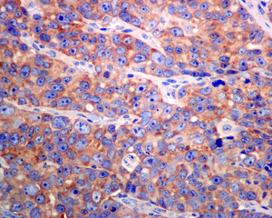 Immunohistochemical analysis of paraffin-embedded Human breast carcinoma tissue labelling ZNF289 with ab133768 at 1/50 dilution.