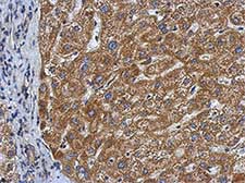 Immunohistochemical analysis of paraffin-embedded Human hepatoma tissue labeling SMYD3 with ab155018 at 1/500 dilution.