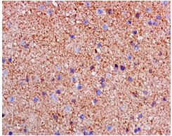 Immunohistochemical analysis of paraffin-embedded Human astrocytoma tissue labeling SNAP47 with ab172609 at 1/50 dilution.