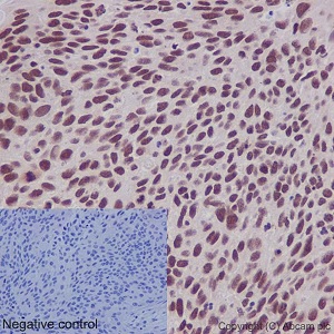 Immunohistochemical analysis of paraffin embedded Human squamous cell carcinoma of cervix tissue sections labeling SNF5 using ab192864 at a 1/1000 dilution. A predilutedHRP Polymer for Rabbit IgG was used as the secondary. Hematoxylin counterstain.