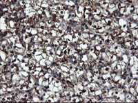 ab128079, at 1/150 dilution, staining SnoN in paraffin-embedded Human kidney carcinoma tissue by Immunohistochemistry.