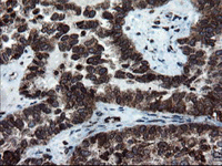 ab128079, at 1/150 dilution, staining SnoN in paraffin-embedded Human ovary adenocarcinoma tissue by Immunohistochemistry.
