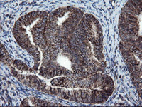 ab128079, at 1/150 dilution, staining SnoN in paraffin-embedded Human endometrium adenocarcinoma tissue by Immunohistochemistry.