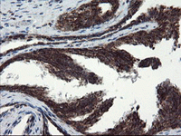 ab128079, at 1/150 dilution, staining SnoN in paraffin-embedded Human prostate carcinoma tissue by Immunohistochemistry.