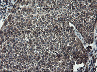 ab128079, at 1/150 dilution, staining SnoN in paraffin-embedded Human bladder carcinoma tissue by Immunohistochemistry.