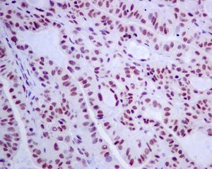 ab128865, at 1/50 dilution, staining SNRPA1 in paraffin-embedded Human thyroid gland carcinoma tissue by Immunohistochemistry.