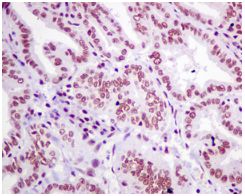 Immunohistochemical analysis of paraffin-embedded Human breast carcinoma tissue labeling SNRPF with ab154870 at 1/50 dilution.
