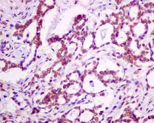 Immunohistochemical analysis of paraffin embedded Human breast carcinoma tissue using ab154870 showing +ve staining.