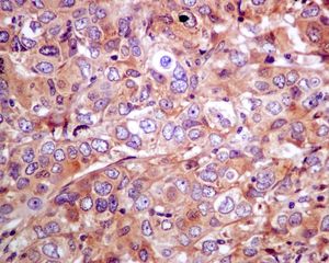 Immunohistochemical analysis of paraffin embedded Human breast carcinoma labelling SNX1 with ab134126 at 1/250.