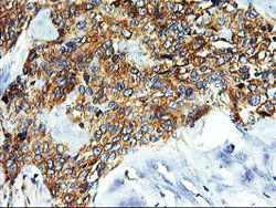 ab119388 at 1/150 dilution staining SNX8 in Paraffin-embedded Human breast adenocarcinoma tissue by Immunohistochemistry.