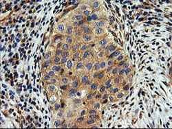 ab119388 at 1/150 dilution staining SNX8 in Paraffin-embedded Human Bladder carcinoma tissue by Immunohistochemistry.