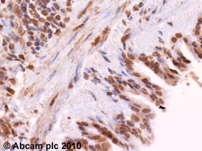 ab62584 (4µg/ml) staining SOCS1 in human lung using an automated system (DAKO Autostainer Plus). Using this protocol there is staining of the cytoplasmic and nuclei of macrophages and some pneumocytes. There was also cytoplasmic and nuclei staining of epithelium cells of the bronchioles.Sections were rehydrated and antigen retrieved with the Dako 3 in 1 AR buffers EDTA pH 9.0 in a DAKO PT link. Slides were peroxidase blocked in 3% H2O2 in methanol for 10 mins. They were then blocked with Dako Protein block for 10 minutes (containing casein 0.25% in PBS) then incubated with primary antibody for 20 min and detected with Dako envision flex amplification kit for 30 minutes. Colorimetric detection was completed with Diaminobenzidine for 5 minutes. Slides were counterstained with Haematoxylin and coverslipped under DePeX. Please note that, for manual staining, optimization of primary antibody concentration and incubation time is recommended. Signal amplification may be required.