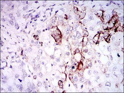 Immunohistochemical analysis of paraffin-embedded Human lung cancer tissue labeling Somatostatin with ab140665 at a 1/200 dilution followed by DAB staining.