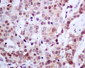 Immunohistochemical analysis of paraffin embedded Human Breast carcinoma tissue using ab140621 showing +ve staining.
