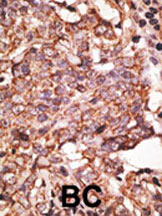 Immunohistochemical analysis of SIGLEC6 expression in formalin-fixed and paraffin-embedded human breast carcinoma tissue using 1/50 ab38581.