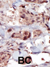 Immunohistochemical staining of SPHK2 in Human breast carcinoma tissue sections (IHC-P - paraformaldehyde-fixed, paraffin-embedded sections) with ab37977 at a dilution of 1/25. Tissue was fixed with formaldehyde and blocked with 3% BSA for 0.5 hours at 38°C. Antigen retrieval was heat mediation with a citrate buffer (pH6). Samples were incubated with primary antibody (1/25) for 1 hour at 37°C. A HRP-conjugated goat anti-rabbit polyclonal (ready to use) was used as the secondary antibody.
