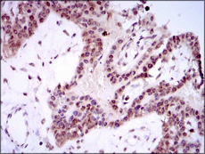 Immunohistochemical analysis of Paraffin-embedded Human ovarian cancer tissue labelling SPIB with ab135238 at 1/200 dilution followed by DAB staining.
