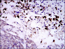 Immunohistochemical analysis of Paraffin-embedded Human esophageal cancer tissue labelling SPIB with ab135238 at 1/200 dilution followed by DAB staining.