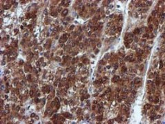 ab119402 at 1/150 dilution staining SPR in paraffin-embedded Human liver carcinoma tissue by Immunohistochemistry.