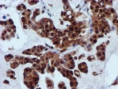 ab119402 at 1/150 dilution staining SPR in paraffin-embedded Human lung carcinoma tissue by Immunohistochemistry.