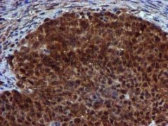 ab119402 at 1/150 dilution staining SPR in paraffin-embedded Human ovary adenocarcinoma tissue by Immunohistochemistry.