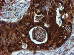 ab119402 at 1/150 dilution staining SPR in paraffin-embedded Human pancreas carcinoma tissue by Immunohistochemistry.
