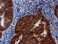 ab119402 at 1/150 dilution staining SPR in paraffin-embedded Human endometrium adenocarcinoma tissue by Immunohistochemistry.