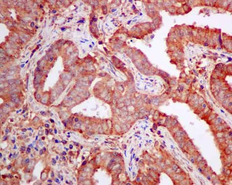 ab157194 showing +ve staining in Human endometrial carcinoma.