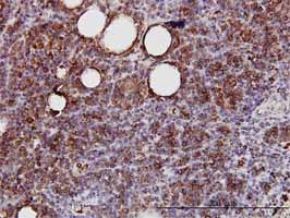 Sprouty 2 antibody (ab60719) used in immunohistochemistry at 3ug/ml on formalin fixed and paraffin embedded human lymphoma.