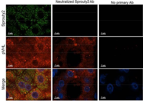 Immunohistochemical analysis of formalin-fixed paraffin-embedded Human kidney clear cell tumor labeling Sprouty 2 with ab191284 at 1/250 dilution. Secondary antibody: Alexa Fluoro 488 secondary at 1/500 dilution. Staining: green = Sprouty 2, Blue = DAPI, red= VHL.