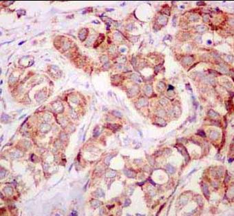 Immunohistochemical analysis of paraffin-embedded Human breast carcinoma tissue labeling Sprouty 2 with ab180527 at 1/50 dilution. The slide is counterstained with Hematoxylin.