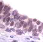 Ab41865 staining human Skp1 in human breast carcinoma by immunohistochemistry using formalin fixed paraffin embedded tissue.